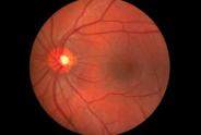 The underdevelopment of the retina is the cause of retinal degeneration in preterm infants.